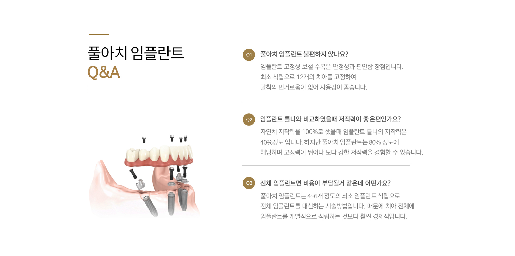 전악 고정 임플란트